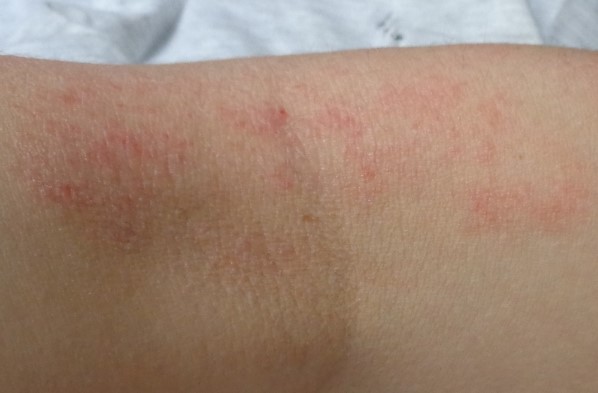 atopijski-dermatitis-2